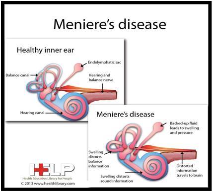 Define Meniere&#39;s disease & its etiology, clinical features & management. | Biyani Group of Colleges